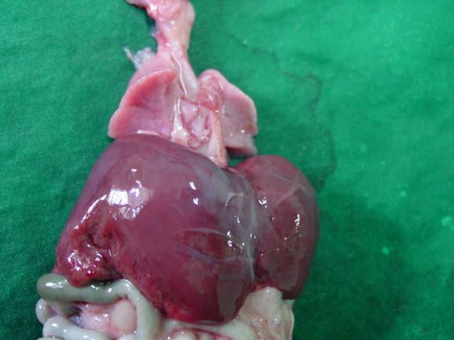 Akinesia Fetal.Hipoplasia Pulmonar - A-05-53. Akinesia Fetal. Hipoplasia Pulmonar